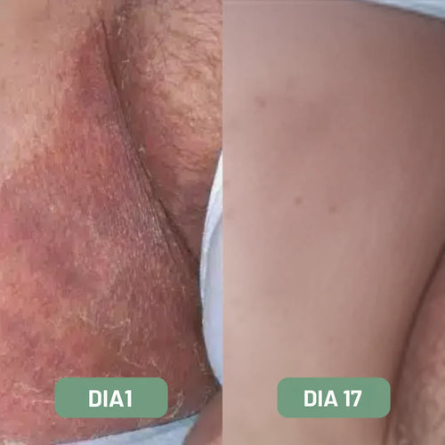 Alivera® Anti-Tiña Inguinal - Formula natural para hongos en la piel