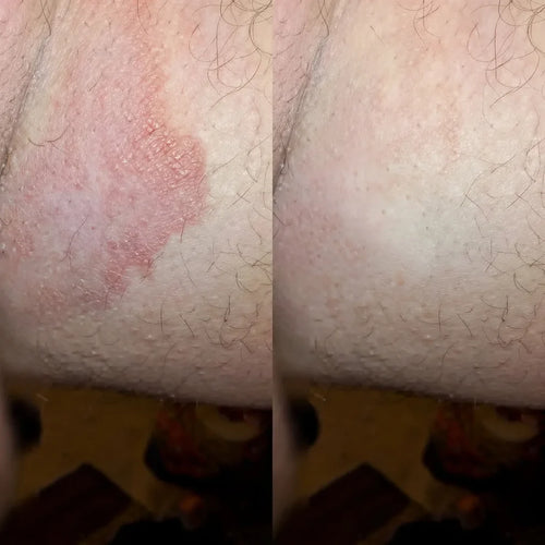 Alivera® Anti-Tiña Inguinal - Formula natural para hongos en la piel